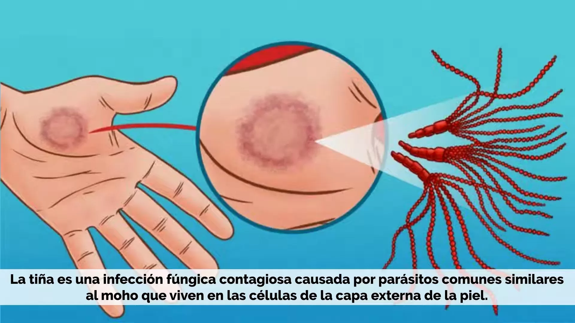 ¿Te pica, se te enrojece la piel y se te pela? Podrías tener tiña corporis