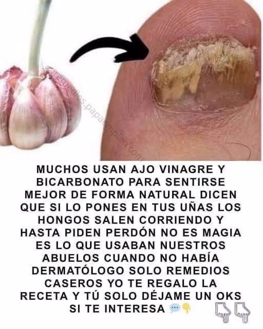 Dile adiós a los hongos en las uñas con esta receta casera que está dando de qué hablar