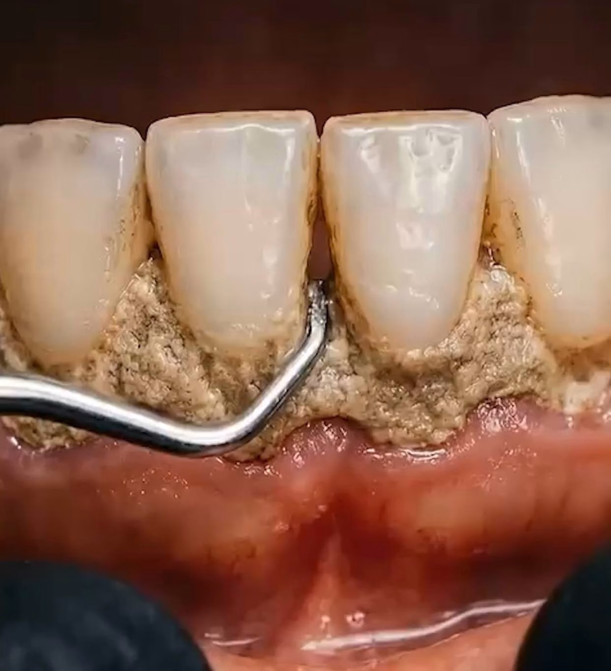 Dile adiós a los dientes amarillos, con esta mezcla tendrás dientes de un artista 😱
