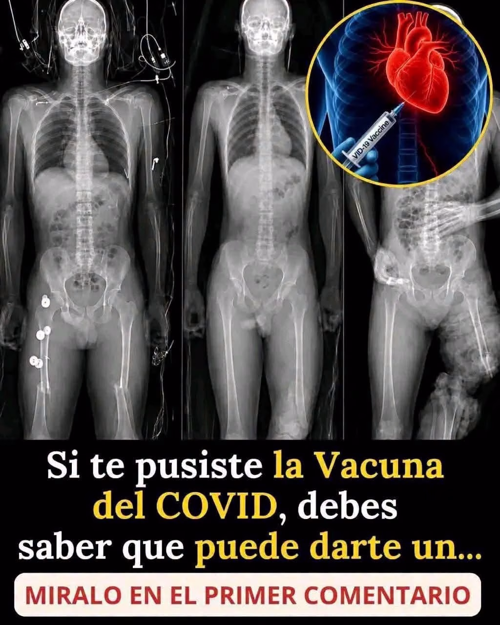 COVID 19. Alerta mundial vacunados científicos descubren nuevo ca…Ver más