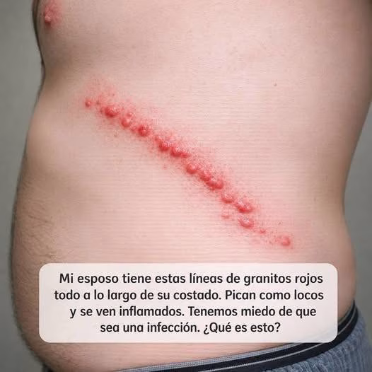 Culebrilla es una enfermedad común que se activa con el estrés