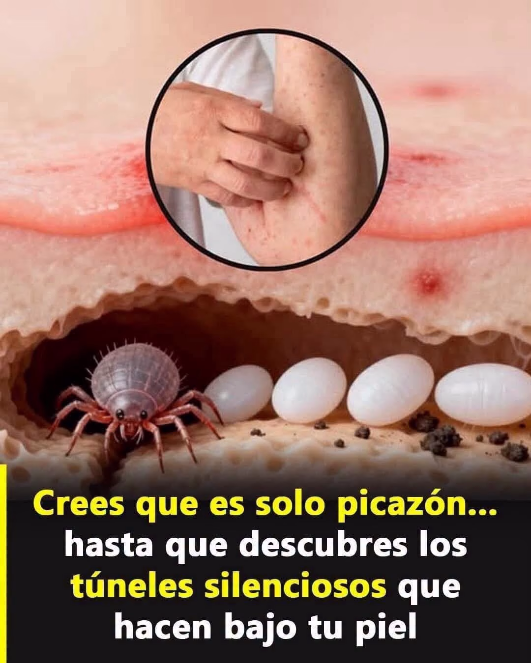 ¿Qué enfermedades pueden ser causadas por los ácaros?